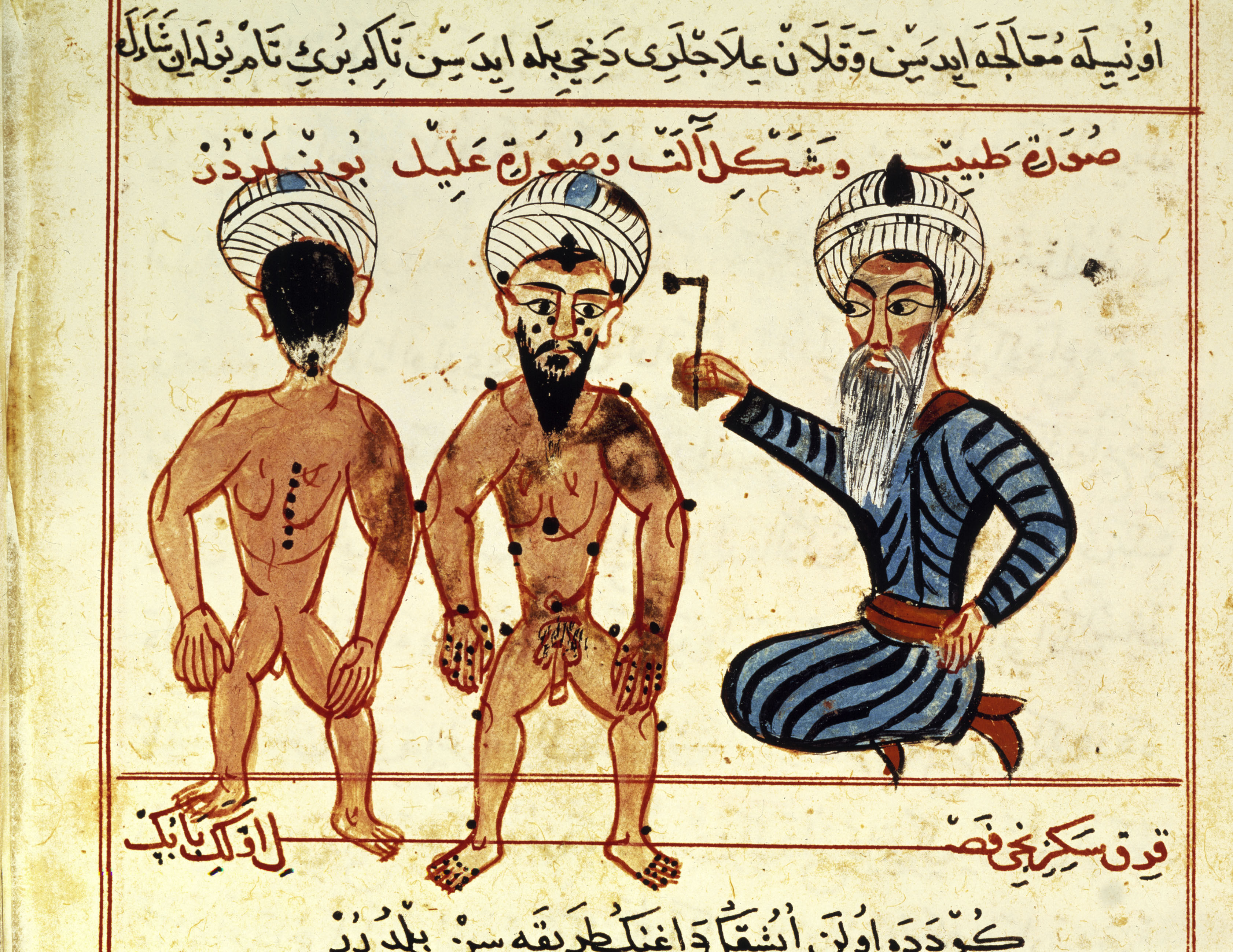 Cauterisation (burning, cauterising) of leprous skin lesions. - Illumination, Turkish, 15th century. Illustration of the Turkish translation of ''Imperial Surgery'' (Persia, 12th century). Ms.Turc. 693, fol.46v. Paris, Bibliotheque Nationale (photo: akg- images/picture-alliance)